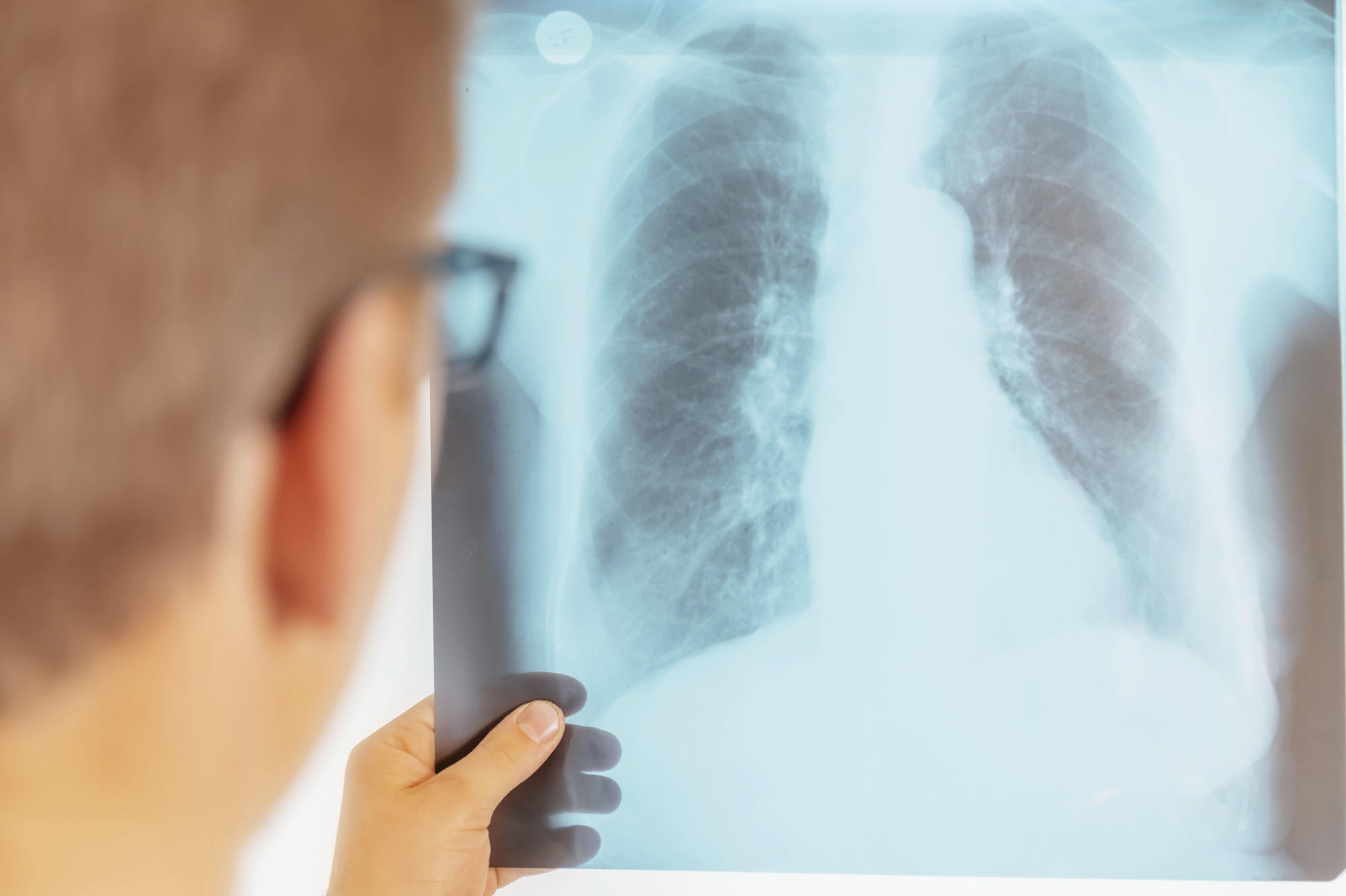 In cases of bacterial pneumonia, inflammation of the lung tissue can often be seen on patients’ X-rays. However, research has yet to be done to see what happens in the lungs when they become infected with pathogens such as pneumococci.