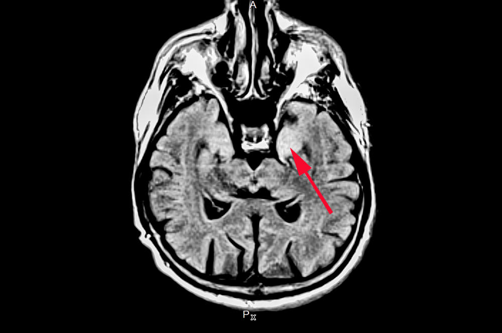 MRI image of a patient with autoimmune brain inflammation: in particular, parts of the temporal lobe (arrow) are especially and frequently affected by the inflammation.